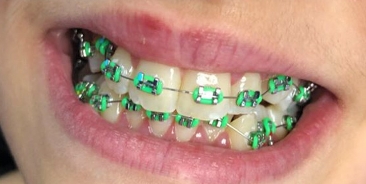 How green braces are perfect choice for your teeth