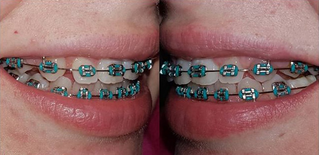 Teal Color Braces