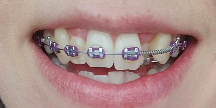 10 good reasons to choose purple braces Braces Explained