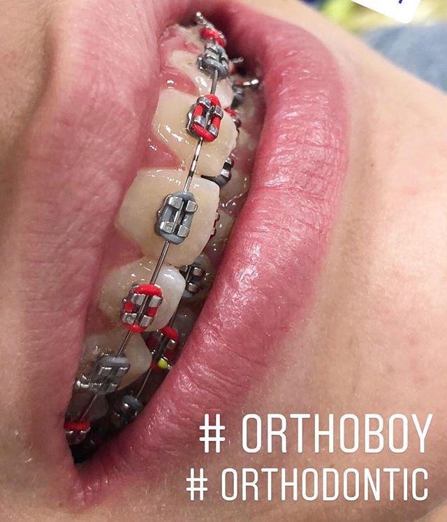 Top 10 colored of red braces for handsome teenage boys