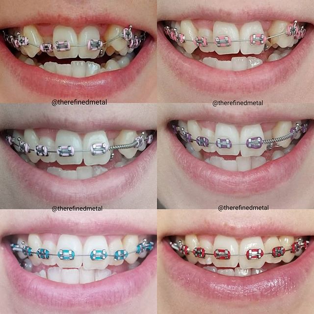 braces colors to make your teeth look white