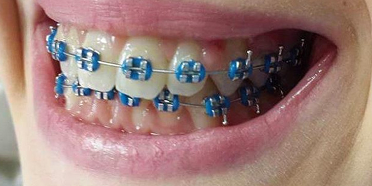 10 colored blue braces for adults and kids | Braces Explained