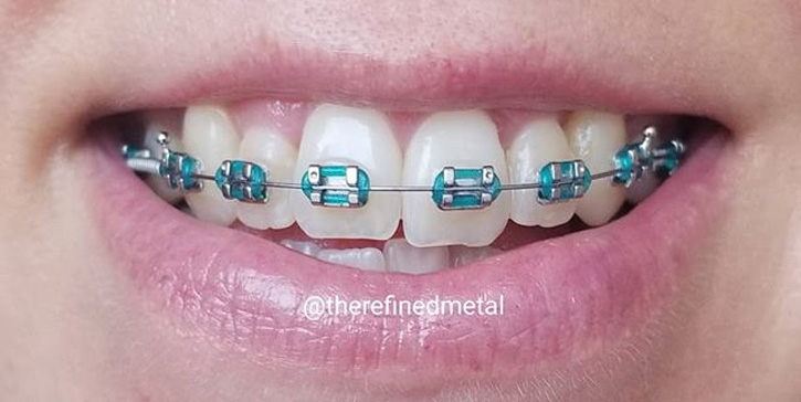 Teal Color Braces