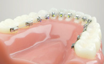 Cost of Lingual Braces