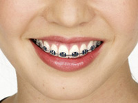 harmony braces